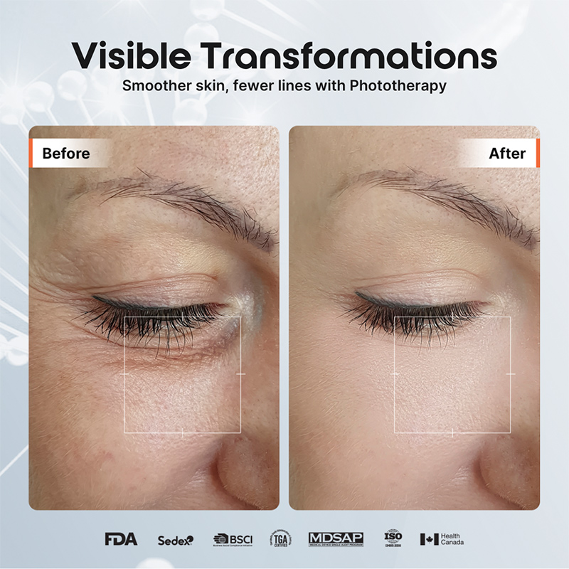 How phototherapy improves skincare results: A guide for beauty brands