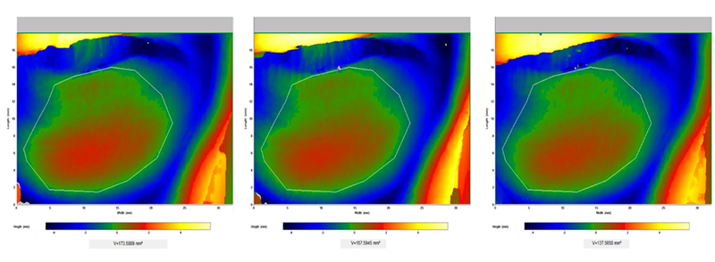 Fig 2: Primos lite clinically recorded volunteer's eye bags change.
